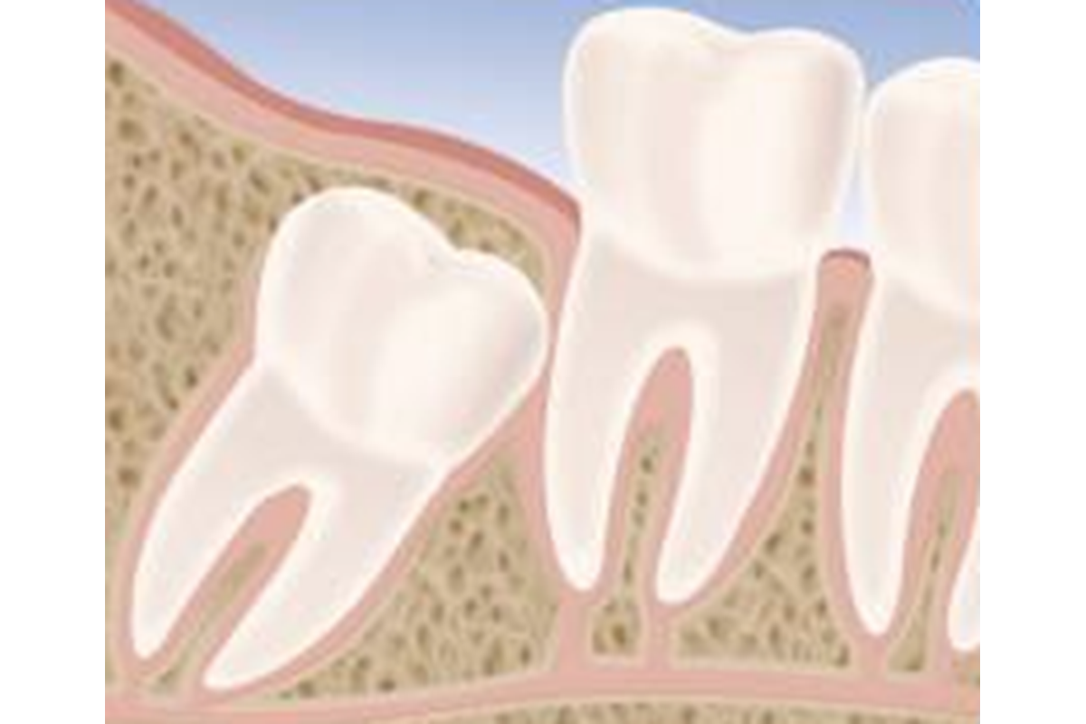 Denti del giudizio: quando rimuoverli?